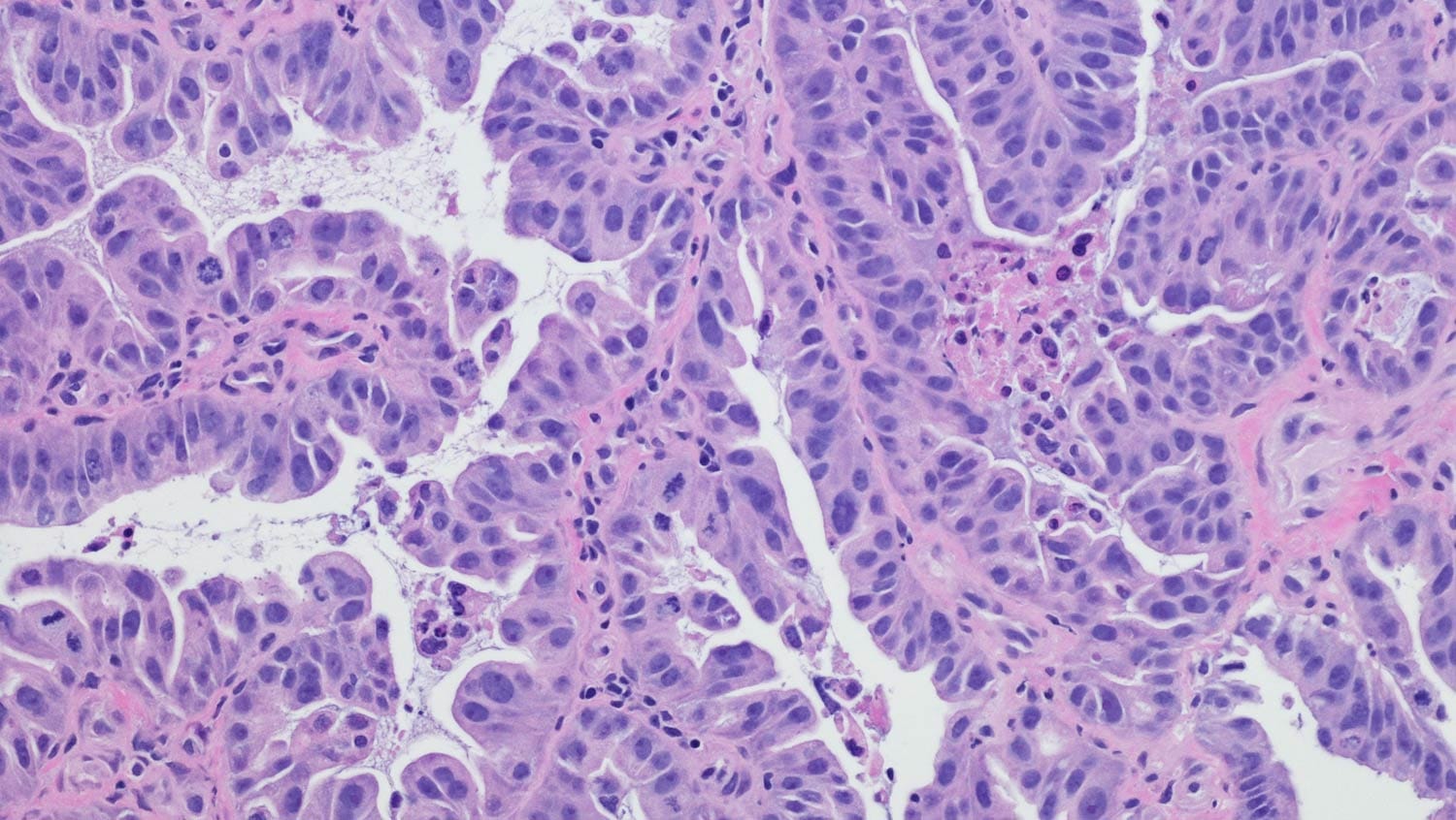 microscopic view of esophageal cancer