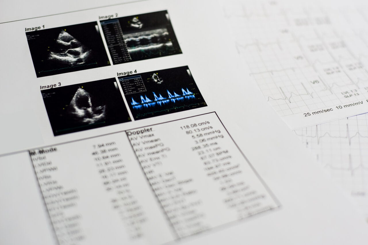 echocardiogram reports
